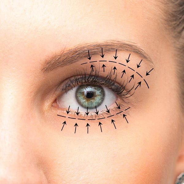 Demonstration of areas targeted by blepharoplasty