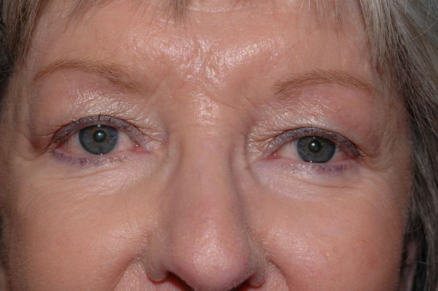 Carmel Cosmetic & Plastic Surgeons' Patient before blepharoplasty